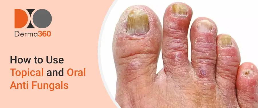 How to Use Topical and Oral Anti Fungals