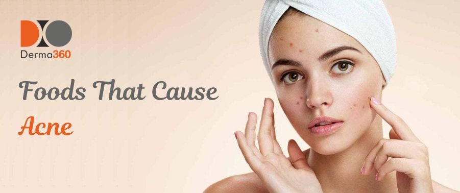 Foods That Cause Acne