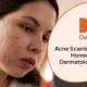 Acne Scarring Pigmentation_ Home Remedies vs Dermatological Treatments 80x80