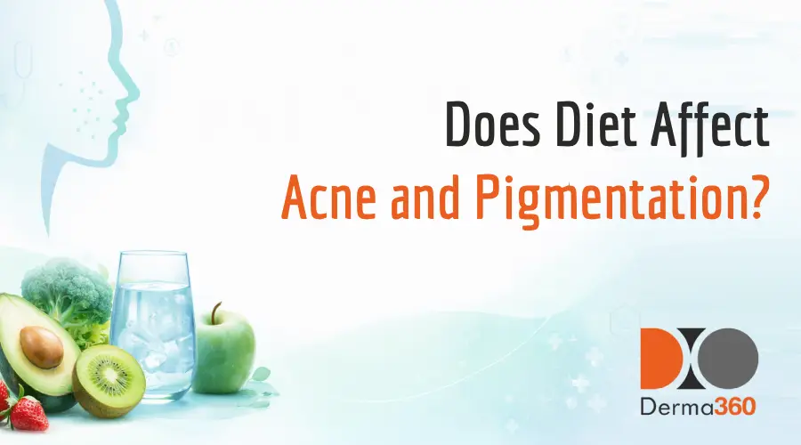 Does Diet Affect Acne and Pigmentation?