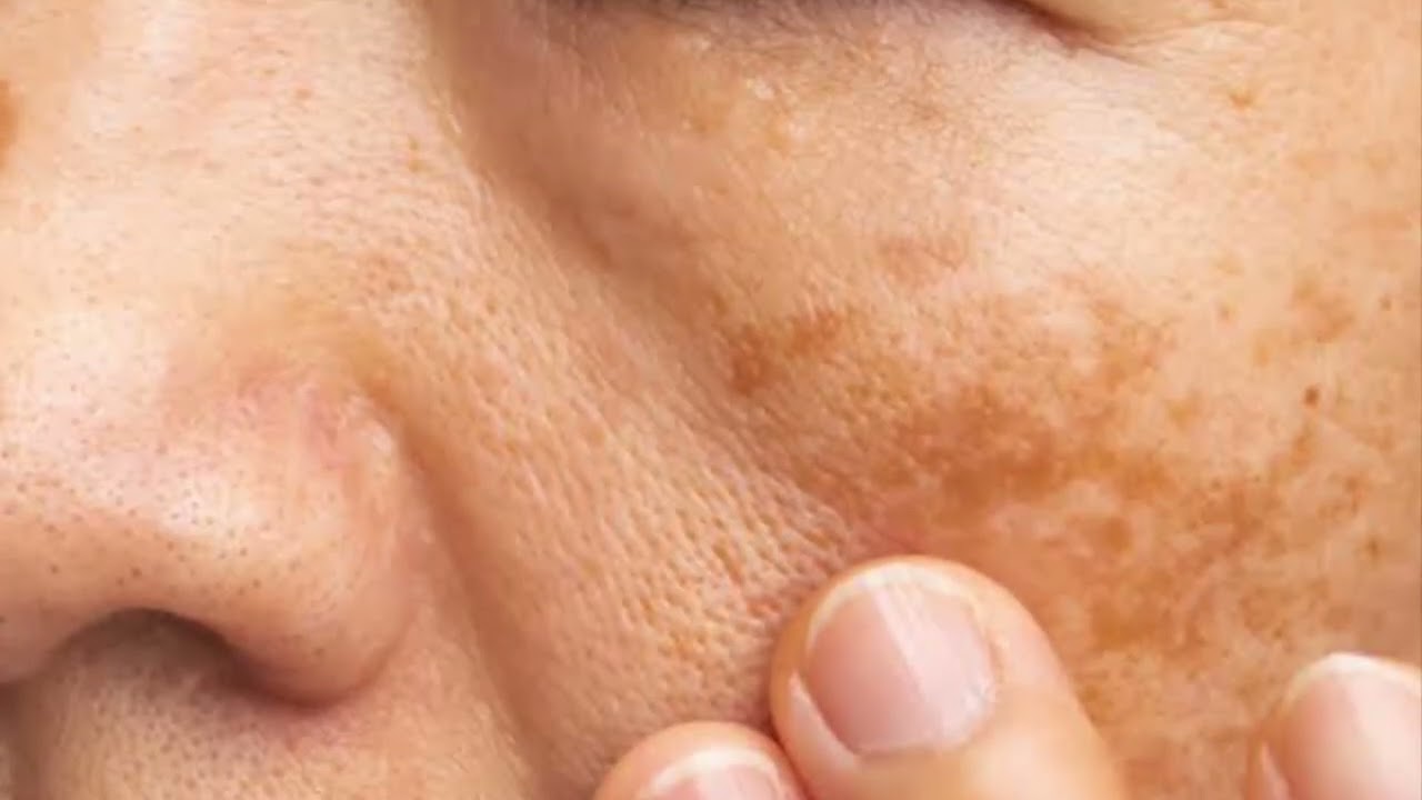 How Sun Exposure Leads to Pigmentation