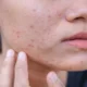 Is Acne Only a Teenage Problem 80x80