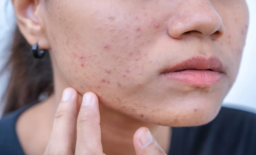 Is Acne Only a Teenage Problem